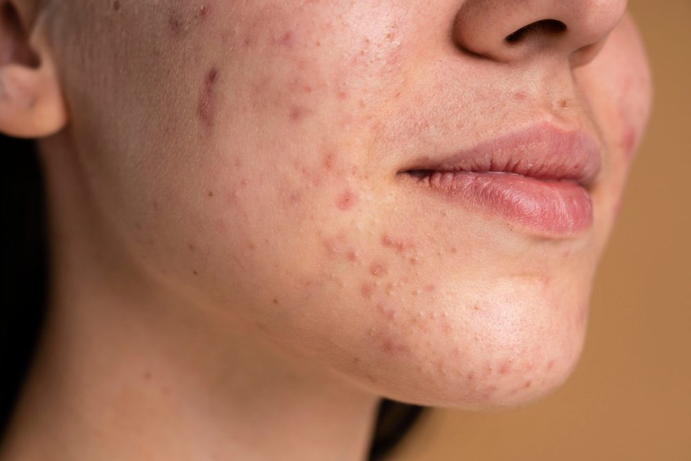 Acne treatment for Hyderabad humidity and Indian skin — ORA Skin & Hair Clinics